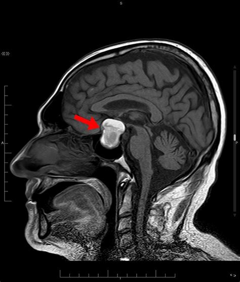 Sagittal Mri T1 Pituitary Macroadenoma With Signs Of Subacute