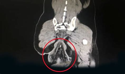 Chinese Mans Rectum Falls Out After 30 Mins On The Toilet Daily Mail