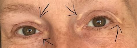Xanthelasma The Yellow Spots On My Eyes What Exactly Are They