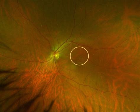 Optomap Ultra Widefield Retinal Imaging