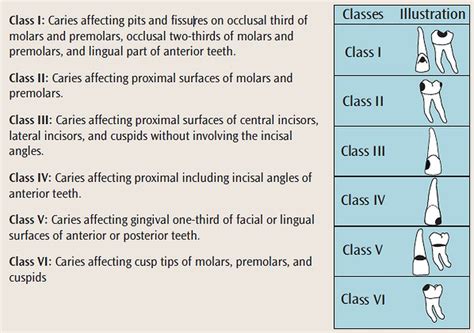 Pdf Dental Caries Definition Classification And Etiology