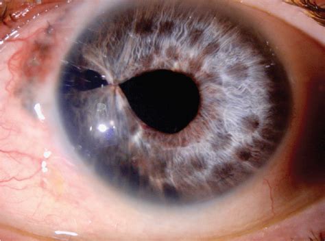 Crsteurope Traumatic Cataract With An Irregular Pupil
