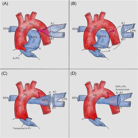 Digital Illustration Of Operative Correction A Illustrating A 10 Mm