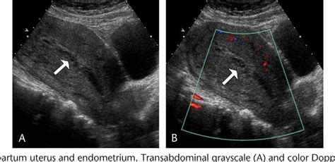 Figure 1 From Ultrasound Of The Postpartum Uterus Semantic Scholar
