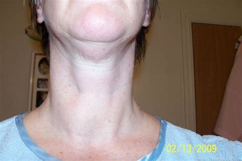 What Its Like To Have Thyroid Surgery Thyroid Treatment Thyroid