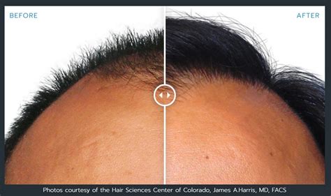 Artas Robotic Hair Restoration Before And After Photos Atlanta
