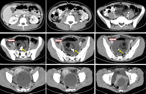 mature ovarian teratoma radiology cases