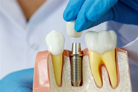 Implanty zębów Warszawa w dzień Wójcik Dental Clinic