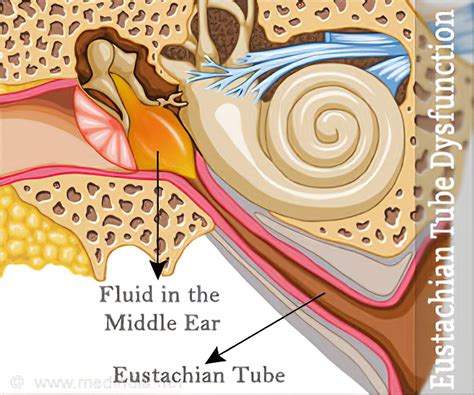 Eustachian Tube Dysfunction Causes Symptoms Diagnosis Treatment
