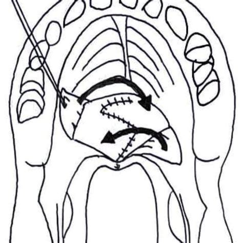 Midline Incision Divides Soft Palate To Posterior Nasal Spine Arrows