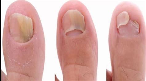 This Super Easy 2 Ingredient Recipe Will Eliminate Your Nail Fungus Forever