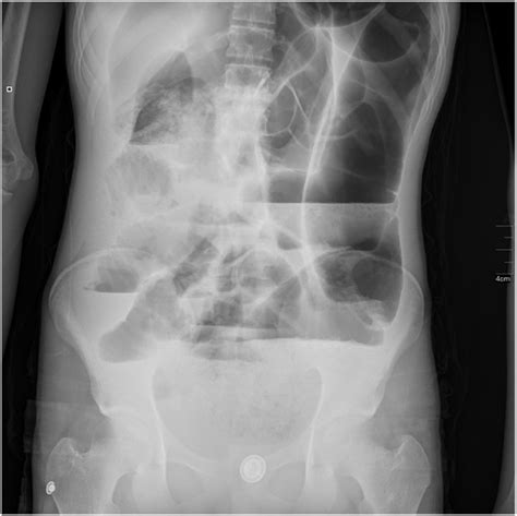 Plain Abdominal X Ray In Erect Position Showing Multiple Air Fluid