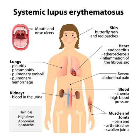 Systemic Lupus Erythematosus Houston Tx Rheumatology And Infectious
