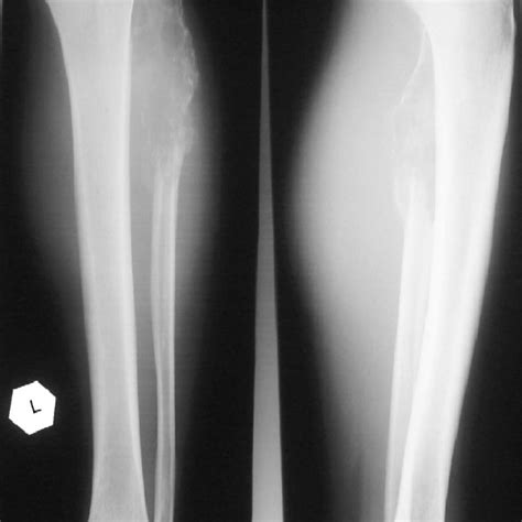 A Plain Radiograph Showing An Osteolytic Mass In The Region Of The Left