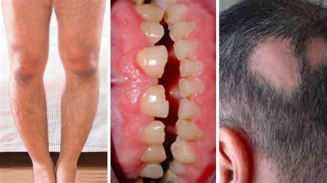Your body has an increased need for vitamin d. My Teeth Started Going Really Bad, This Is How I Realized ...