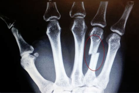 Fractured 4th Metacarpal Update After Orthopedic Followup Hand