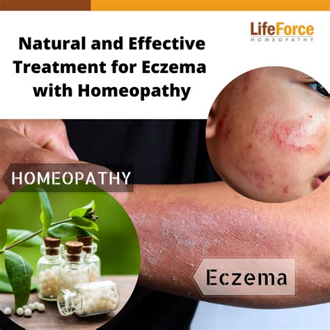Natural And Effective Treatment For Eczema With Homeopathy