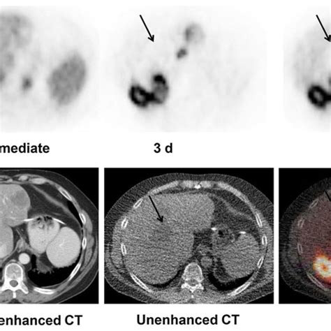 Patient 18 With Colorectal Cancer Metastatic To Liver Download