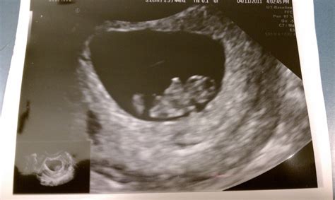 All You Knew Was Love 8 Week Ultrasound And Appt