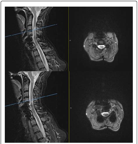 Mri Sagittal T2stir And Axial T2 Sequences Of The Cervical Spine