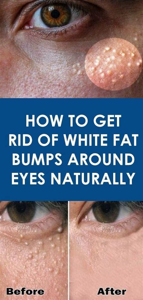 The Small White Bumps On Your Skin Which Usually Appear Around Your