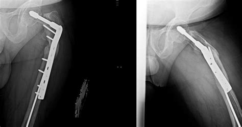 A B Ap And Lateral Radiographs Of The Left Hip At Most Recent Follow
