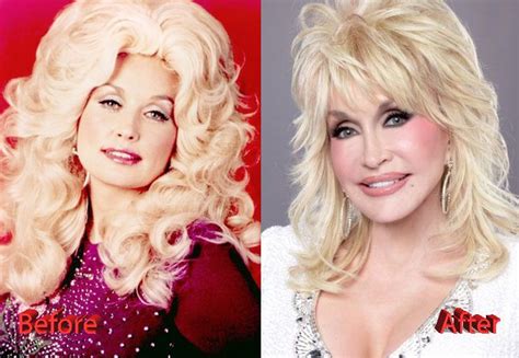 Dolly Parton Before And After Plastic Surgery Laser Hair Removal