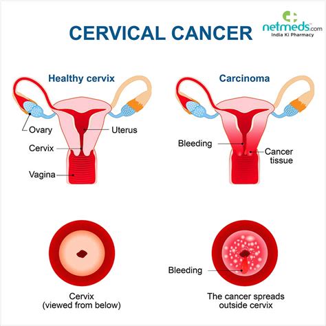 Cervical Cancer Causes Symptoms And Treatment Netmeds