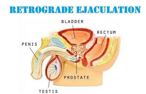 Retrograde Ejaculation Treatment In Lahore How To Treat