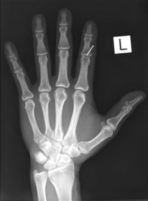 Mastering Minor Care Hand Lacerations — Taming The Sru