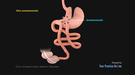 One Anastomosis Gastric Bypass Video Medical Video Library