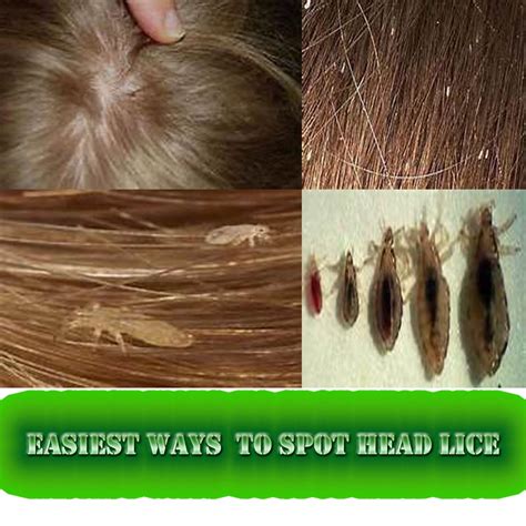 Easiest Ways Reduce And Remove Head Lice