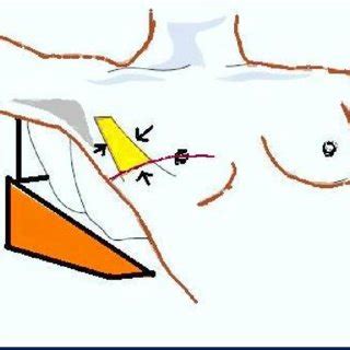 With the arm abducted, the apex is the axilla, and the triangle is formed by the: Safety triangle for chest tube insertion (yellow area ...