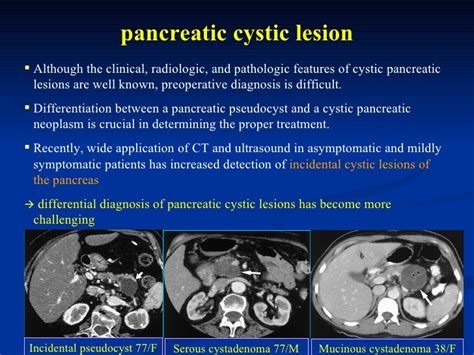 Diagnosis And Management Of Pancreatic Cystic Lesion