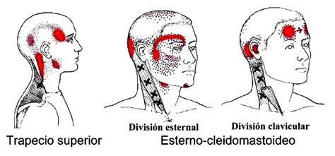 Fisioterapia Cranium Dolor de cabeza tipos y causas más frecuentes