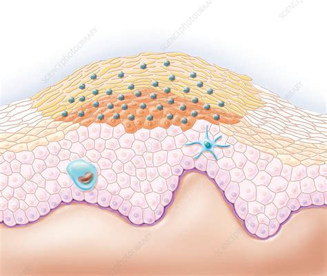 Wart Structure Artwork Stock Image C0107438 Science Photo Library