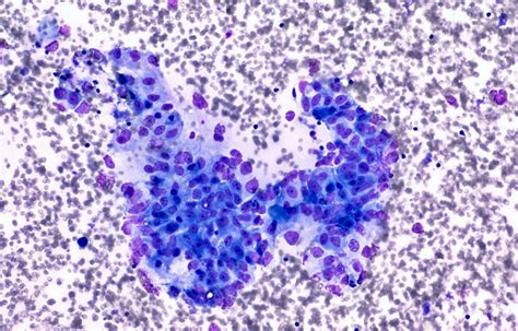 Pancreatic Cancer Blocked By Disrupting Cellular Ph Balance Sanford