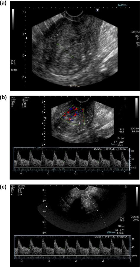 Table 1 From Role Of Transvaginal Ultrasonography And Colour Doppler In