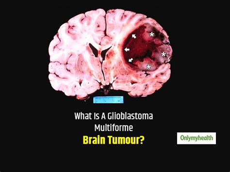 world brain day 2020 causes symptoms and treatment of glioblastoma multiforme gbm