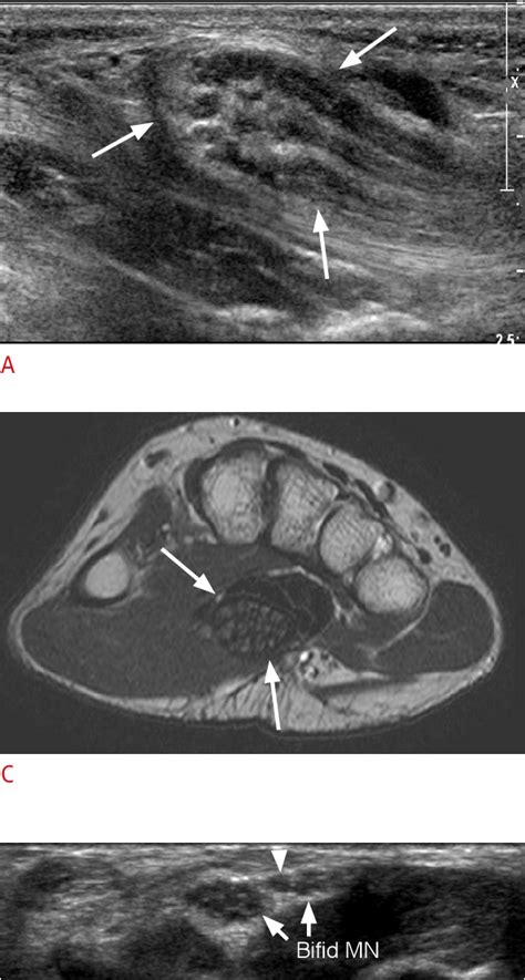 Figure 3 From Ultrasonography For Nerve Compression Syndromes Of The