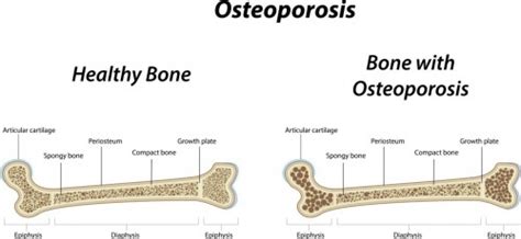 Osteoporosis And The Ways To Deal With It