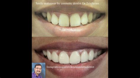 How To Get Straight Teeth Without Braces Best Cosmetic Dentist Dr