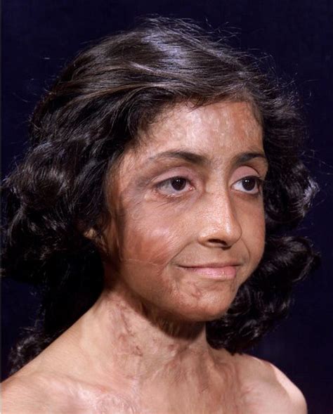 Burn Victim Gets Amazing Facial Reconstruction 4 Pics