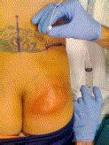 This type of nerve pain in teeth occurs when the tooth. Superior Cluneal Nerve Block for Treatment of Buttock ...