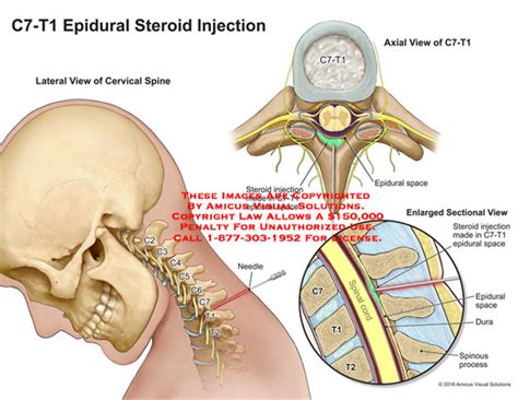 Amicus Illustration Of Amicus Medical Injections Epidural C T
