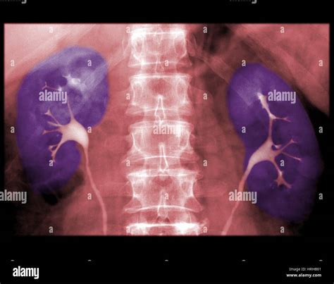 Normal Xray Of Urinary System Hi Res Stock Photography And Images Alamy
