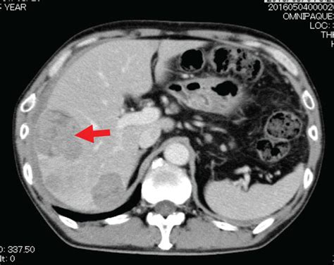 Ct Scan Showing Multiple Liver Metastases Suggestive Of Hepatocellular