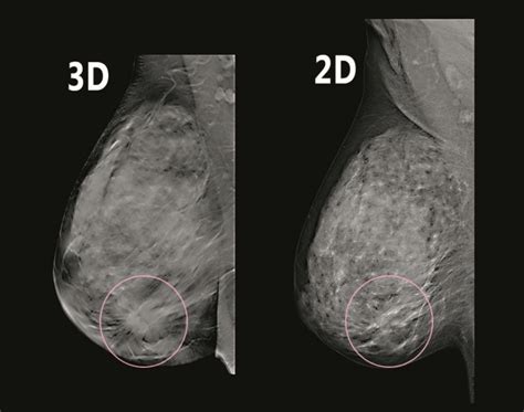 3d mammography diagnostic outpatient imaging