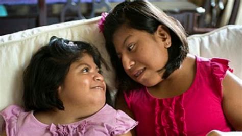 Conjoined Twins Separated Josie Hull Teresa Cajas Turn 21 And