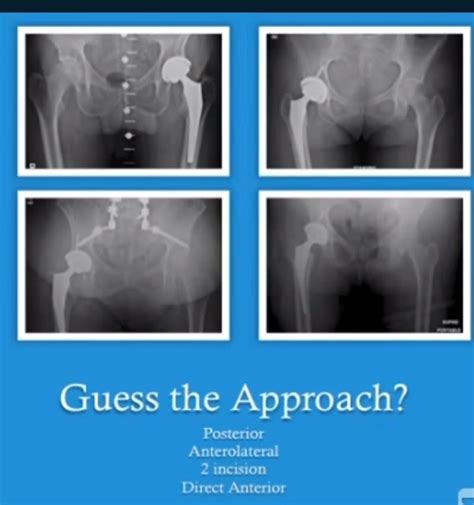 Approaches For Hip Replacement —